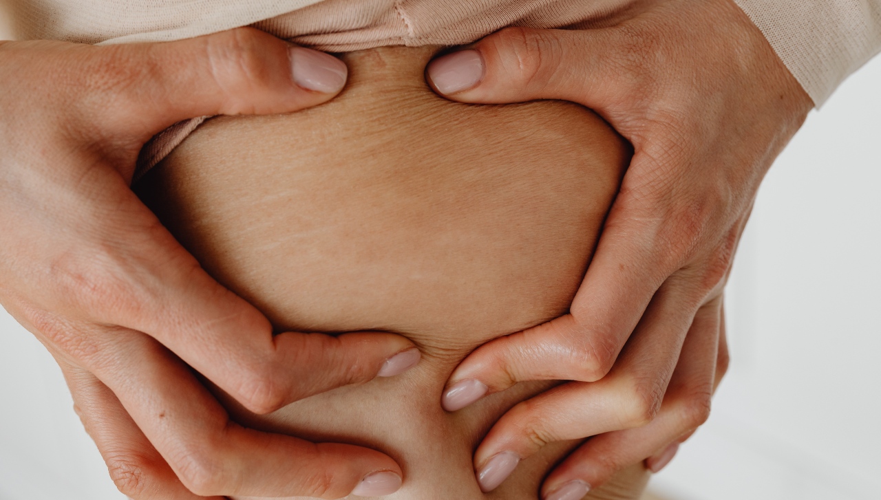 Walau Tidak Bisa Hilang Sepenuhnya, Tetap Ada Kiat Untuk Meminimalisir Tampilan Stretch Marks 